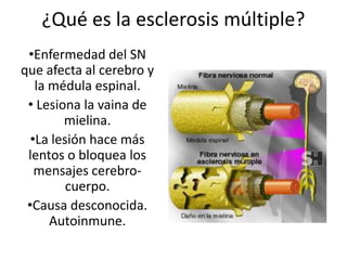 ¿Qué es la esclerosis múltiple?
•Enfermedad del SN
que afecta al cerebro y
la médula espinal.
• Lesiona la vaina de
mielina.
•La lesión hace más
lentos o bloquea los
mensajes cerebrocuerpo.
•Causa desconocida.
Autoinmune.

 