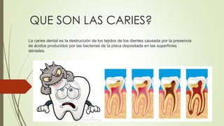 QUE SON LAS CARIES?
La caries dental es la destrucción de los tejidos de los dientes causada por la presencia
de ácidos producidos por las bacterias de la placa depositada en las superficies
dentales.
 