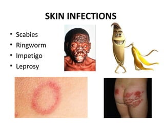 SKIN INFECTIONS
• Scabies
• Ringworm
• Impetigo
• Leprosy
 