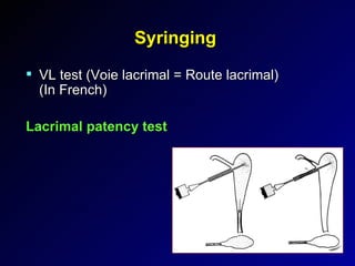 Syringing VL test (Voie lacrimal = Route lacrimal) (In French) Lacrimal patency test 