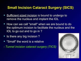 Small Incision Cataract Surgery (SICS) Sufficient sized incision  is bound to undergo to remove the nucleus and implant the IOL How can we call "small" when we are bound to do the optimum incision to facilitate the nucleus and the IOL to go out and to go in ? Is there any big incision ? "Small" the word is a relative - Tunnel incision cataract surgery (TICS) 