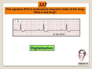 This signature ECG is produced by long term intake of this drug.
What is that drug?
Digitalization
117
PREPP-19
 