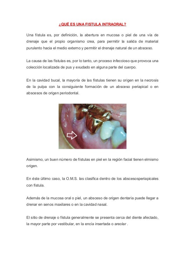 Qué es una fistula intraoral