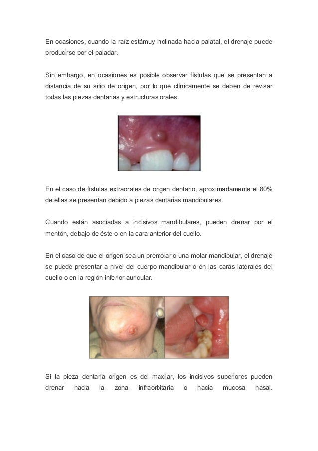 Qué es una fistula intraoral