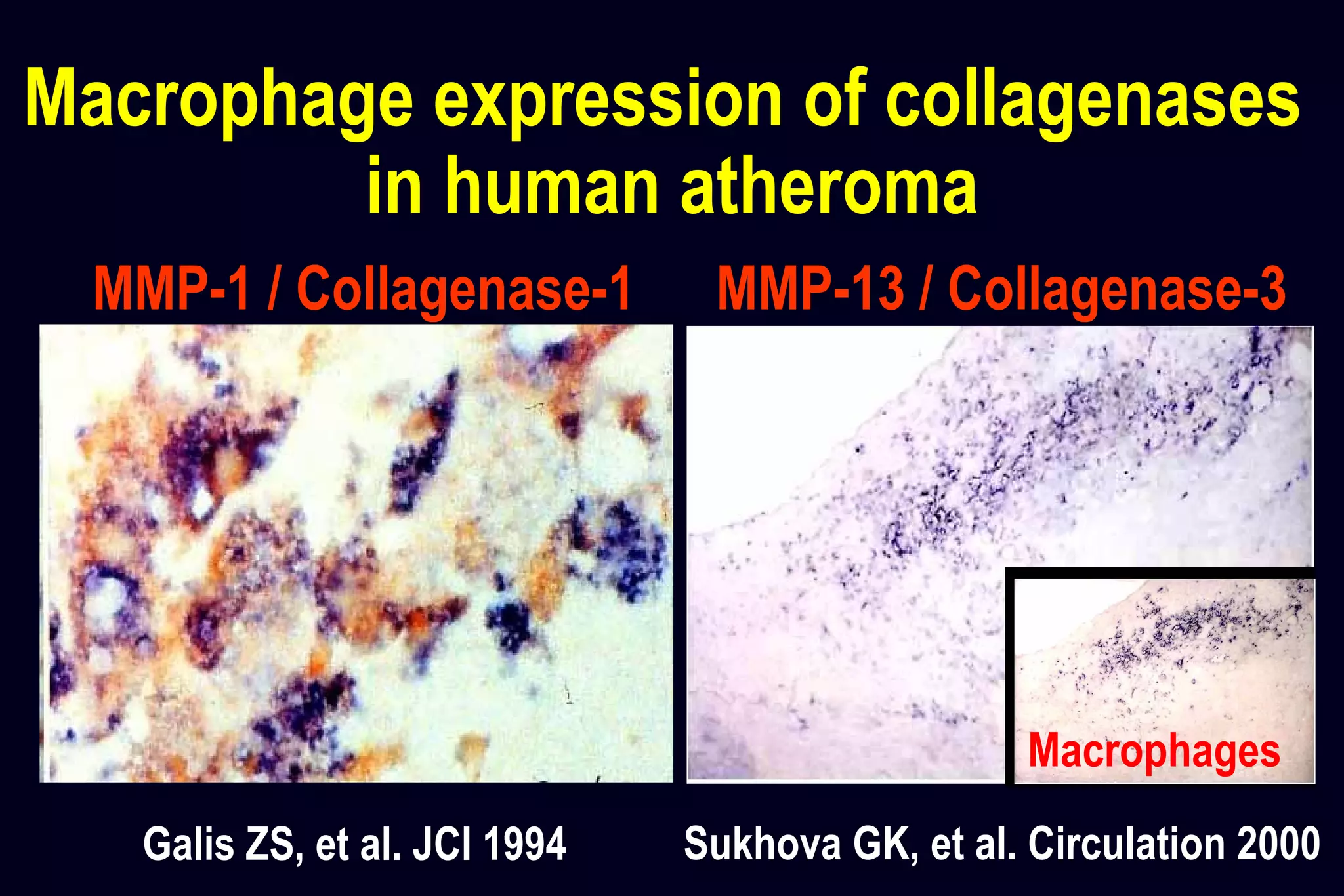 Macrophage expression of collagenases
in human atheroma
Galis ZS, et al. JCI 1994 Sukhova GK, et al. Circulation 2000
MMP-1 / Collagenase-1 MMP-13 / Collagenase-3
Macrophages
 