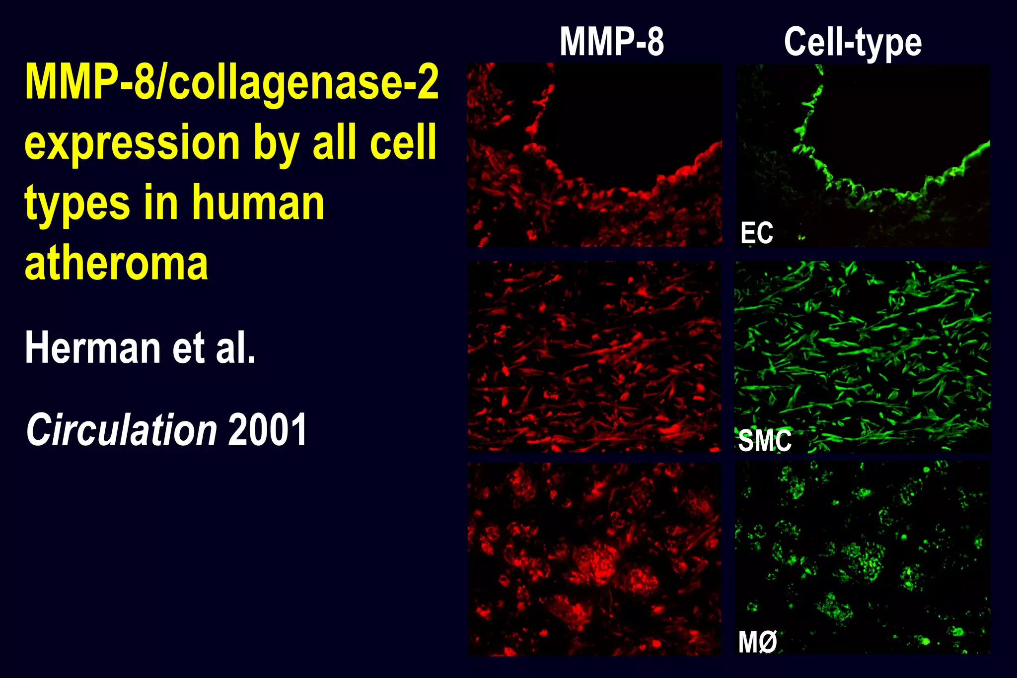 Cell-typeMMP-8
EC
SMC
MØ
MMP-8/collagenase-2
expression by all cell
types in human
atheroma
Herman et al.
Circulation 2001
 