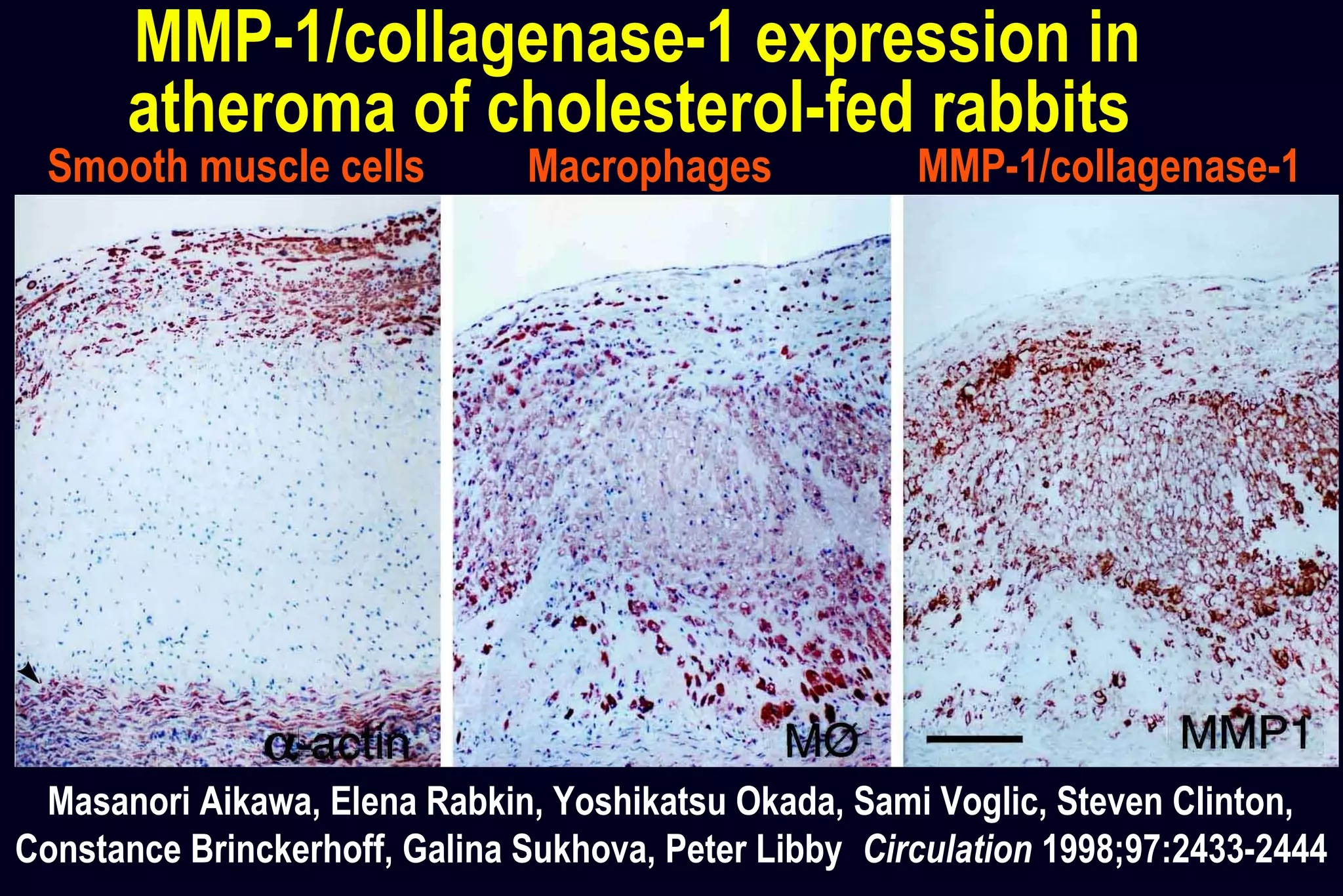 MMP-1/collagenase-1 expression in
atheroma of cholesterol-fed rabbits
Smooth muscle cells Macrophages MMP-1/collagenase-1
Masanori Aikawa, Elena Rabkin, Yoshikatsu Okada, Sami Voglic, Steven Clinton,
Constance Brinckerhoff, Galina Sukhova, Peter Libby Circulation 1998;97:2433-2444
 