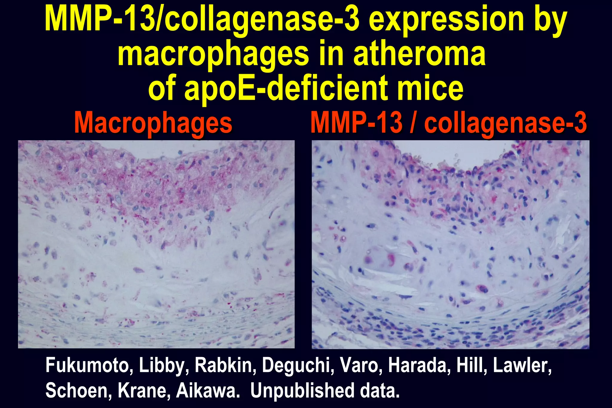 MMP-13/collagenase-3 expression by
macrophages in atheroma
of apoE-deficient mice
MacrophagesMacrophages MMP-13 / collagenase-3MMP-13 / collagenase-3
Fukumoto, Libby, Rabkin, Deguchi, Varo, Harada, Hill, Lawler,
Schoen, Krane, Aikawa. Unpublished data.
 