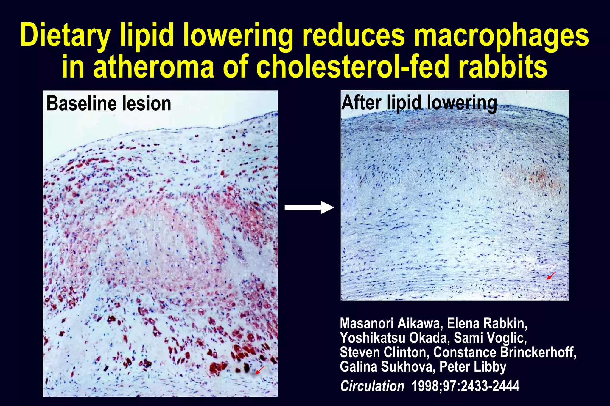 Dietary lipid lowering reduces macrophages
in atheroma of cholesterol-fed rabbits
Baseline lesion After lipid lowering
Masanori Aikawa, Elena Rabkin,
Yoshikatsu Okada, Sami Voglic,
Steven Clinton, Constance Brinckerhoff,
Galina Sukhova, Peter Libby
Circulation 1998;97:2433-2444
 