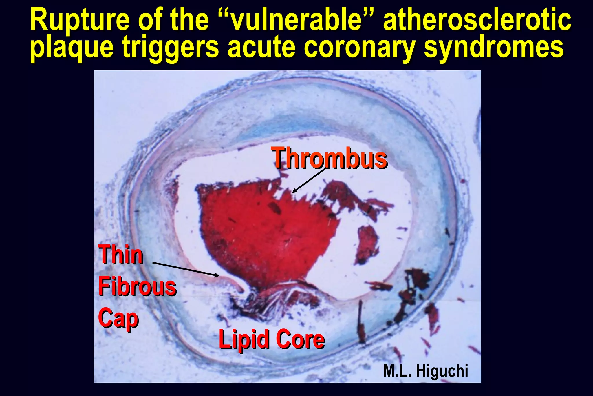 M.L. Higuchi
ThrombusThrombus
ThinThin
FibrousFibrous
CapCap
Lipid CoreLipid Core
Rupture of the “vulnerable” atheroscleroticRupture of the “vulnerable” atherosclerotic
plaque triggers acute coronary syndromesplaque triggers acute coronary syndromes
 