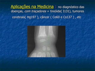 Aplicações na Medicina  :   no diagnóstico das doenças,  com traçadores  = tireóide( I131), tumores cerebrais( Hg197 ), câncer ( Co60 e Cs137 ) , etc   