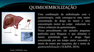 QUIMIOEMBOLIZAÇÃO 
Uma combinação da embolização com a 
quimioterapia, onde consegue-se uma maior 
concentração da droga no tumor e uma 
concentração menor no corpo reduzindo os 
efeitos colaterais da quimioterapia. 
Nesse procedimento são ejetados pequenas 
partículas para bloquear o que alimenta o 
tumor, permitindo que a droga fique 
concentrada por um tempo maior causando a 
morte do tumor por isquemia; dai o nome de 
quimioembolização ( ELKINS, 2014). 
Fonte: GOOGLE, 2014 
 
