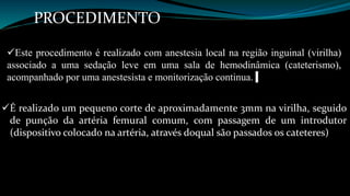 PROCEDIMENTO 
Este procedimento é realizado com anestesia local na região inguinal (virilha) 
associado a uma sedação leve em uma sala de hemodinâmica (cateterismo), 
acompanhado por uma anestesista e monitorização continua. 
É realizado um pequeno corte de aproximadamente 3mm na virilha, seguido 
de punção da artéria femural comum, com passagem de um introdutor 
(dispositivo colocado na artéria, através doqual são passados os cateteres) 
 