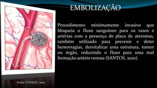 EMBOLIZAÇÃO 
Procedimento minimamente invasivo que 
bloqueia o fluxo sanguíneo para os vasos e 
artérias com a presença de placa de ateromas, 
também utilizado para prevenir e deter 
hemorragias, desvitalizar uma estrutura, tumor 
ou órgão, reduzindo o fluxo para uma mal 
formação artério venosa (SANTOS, 2010). 
Fonte: GOOGLE, 2014 
 