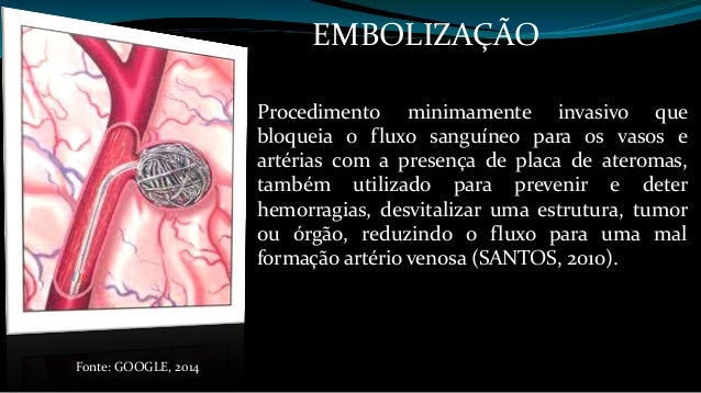 Embolização/Quimioembolização