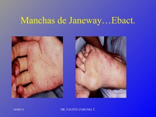 Manchas de Janeway…Ebact. 14/06/11 DR. FAUSTO ZARUMA T. 