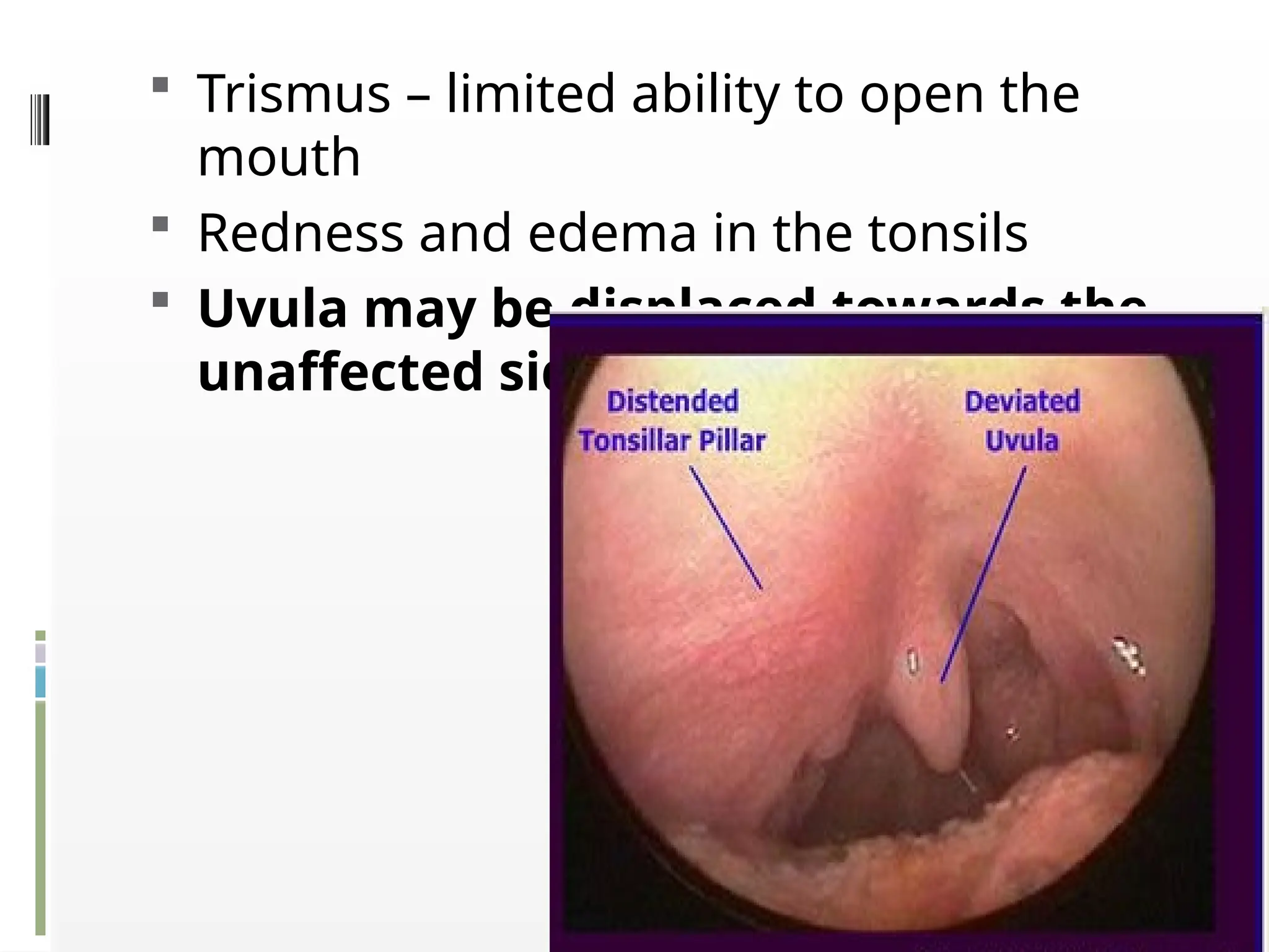 A Tonsillar Abscess is a collection of pus that forms in one of the ...