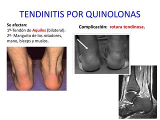 TENDINITIS POR QUINOLONAS
Se afectan:
1º-Tendón de Aquiles (bilateral).
2º- Manguito de los rotadores,
mano, bíceps y muslos.
Complicación: rotura tendinosa.
 