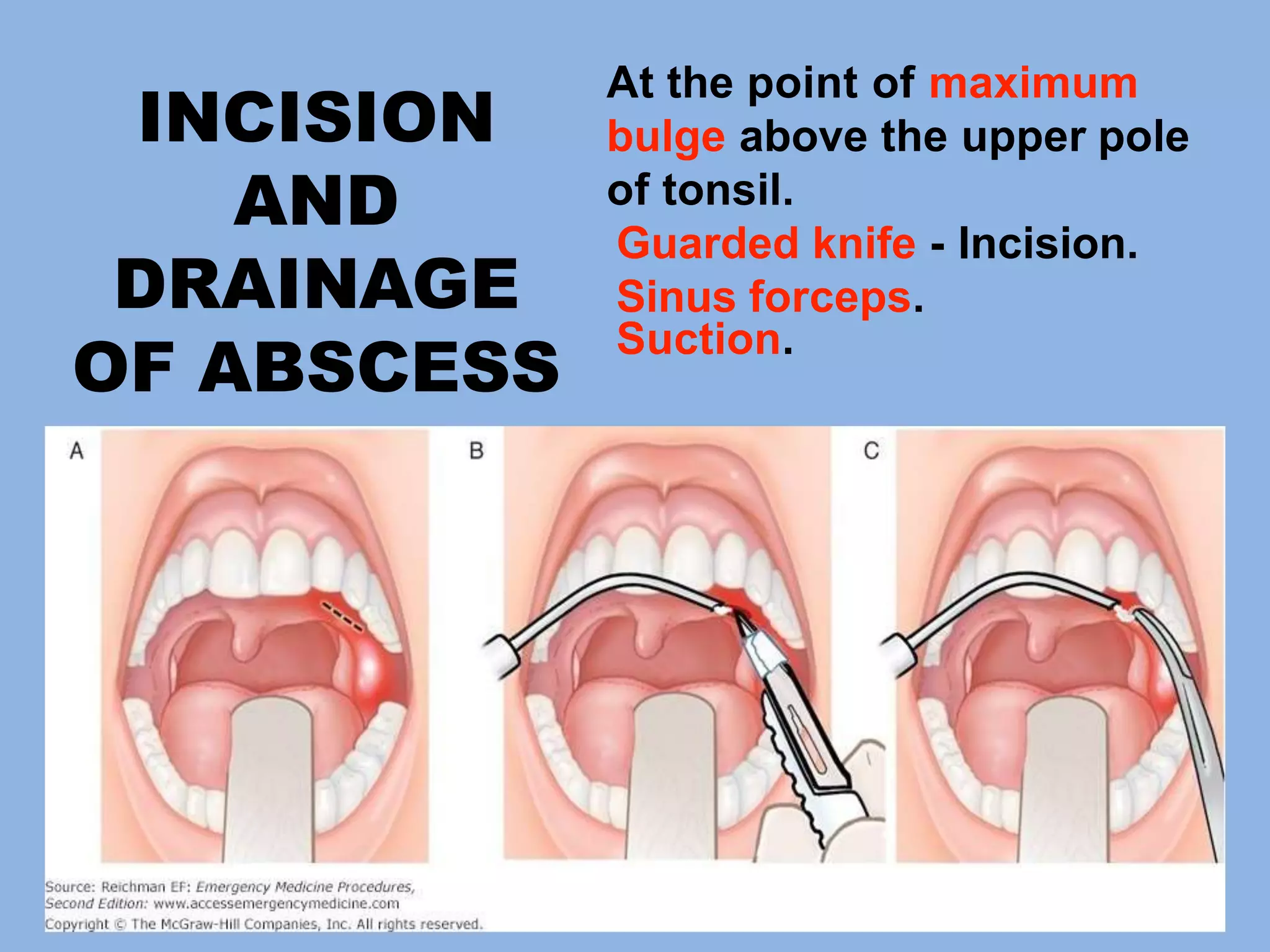 Quinsy or Peritonsillar Abscess | PPTX