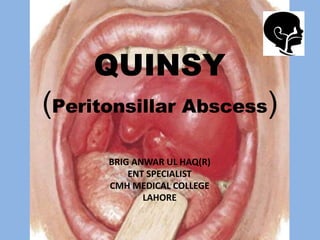 QUINSY
(Peritonsillar Abscess)
BRIG ANWAR UL HAQ(R)
ENT SPECIALIST
CMH MEDICAL COLLEGE
LAHORE
 