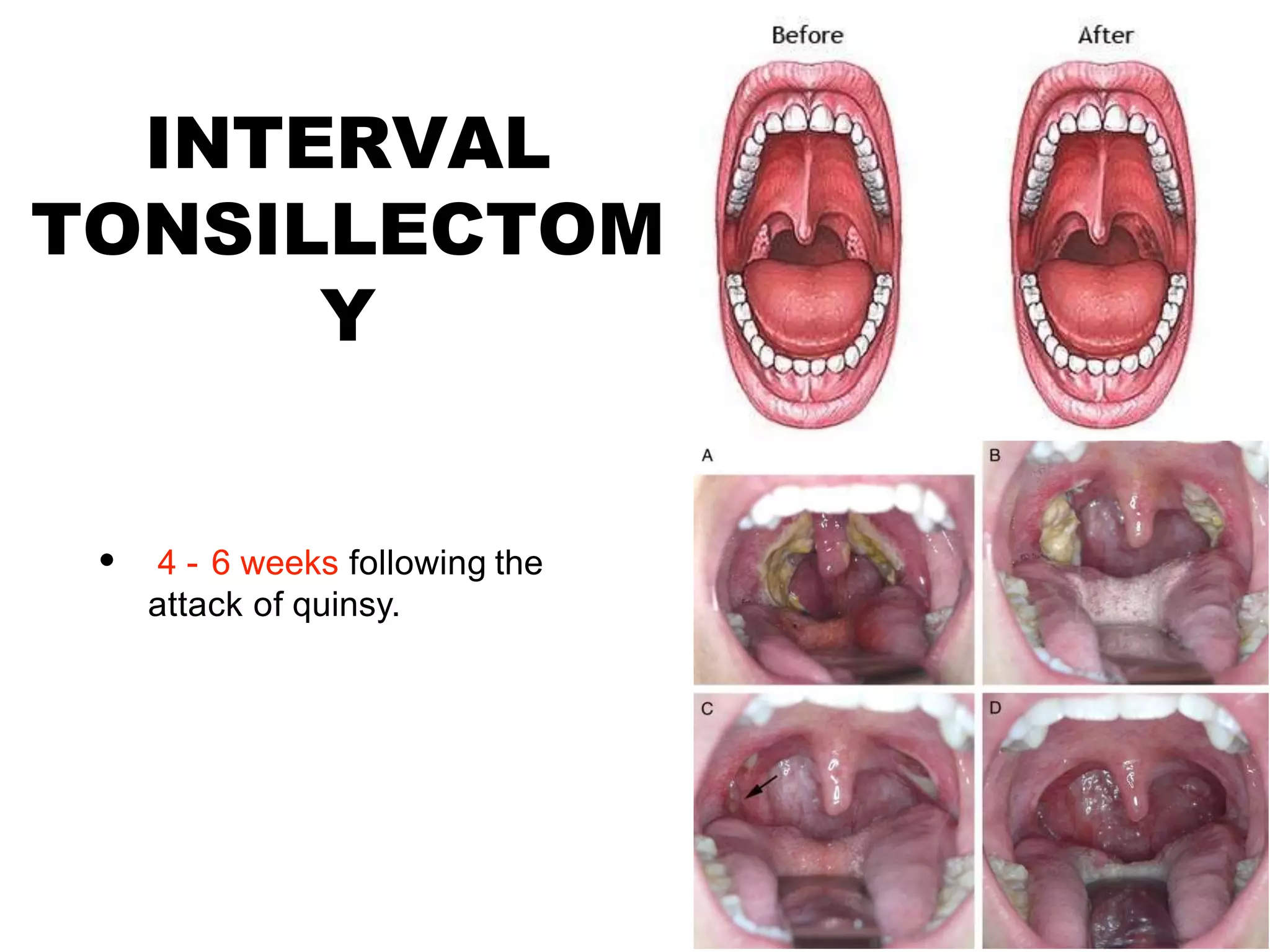 quinsy-or-peritonsillar-abscess-pptx