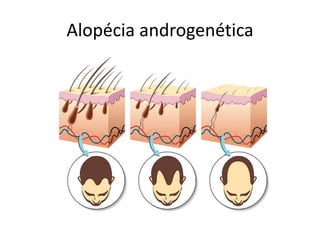 Alopécia androgenética
 