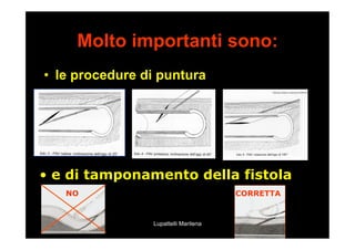 17/01/17 Lupattelli Marilena
Molto importanti sono:
•  le procedure di puntura
•  e di tamponamento della fistola
NO CORRETTA
 