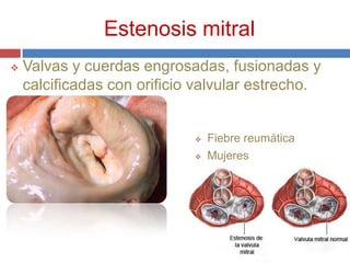 Estenosis mitral
   Valvas y cuerdas engrosadas, fusionadas y
    calcificadas con orificio valvular estrecho.
    estrecho.

                                 Fiebre reumática
                                 Mujeres




                          6
 