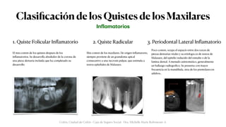 Clasi
fi
cación de los Quistes de los Maxilares
In
f
l
a
m
a
torios
Colón, Ciudad de Colón - Caja de Seguro Social - Dra. Michelle Marie Rohrmoser A.
3. Periodontal Lateral In
fl
amatorio
2. Quiste Radicular
1. Quiste Folicular In
fl
amatorio
El m
á
s com
ú
n de los quistes despu
é
s de los
in
fl
amatorios. Se desarrolla alrededor de la corona de
una pieza dentaria incluida que ha completado su
desarrollo
M
á
s com
ú
n de los maxilares. De origen in
fl
amatorio,
siempre proviene de un granuloma apical
consecutivo a una necrosis pulpar, que estimula a
restos epiteliales de Malassez.
Poco com
ú
n, ocupa el espacio entre dos ra
í
ces de
piezas dentarias vitales y su etiolog
í
a es de restos de
Malassez, del epitelio reducido del esmalte o de la
l
á
mina dental. A menudo asintom
á
tico, generalmente
un hallazgo radiogr
á
fi
co. Se presenta con mayor
frecuencia en la mand
í
bula,
á
rea de los premolares en
adultos..
 