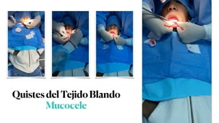 QuistesdelTejidoBlando
Mucocele
 