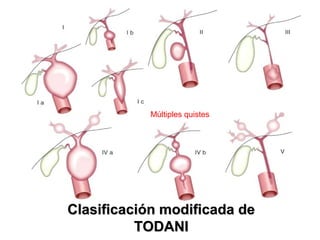 Clasificación modificada deClasificación modificada de
TODANITODANI
5% 5%
Múltiples quistes
30-40%
 