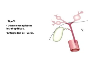 Tipo V:Tipo V:
• Dilataciones quísticas
intrahepáticas.
•Enfermedad de Caroli.
 