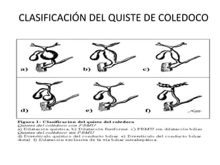CLASIFICACIÓN DEL QUISTE DE COLEDOCO
 