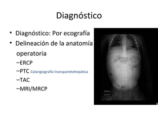Diagnóstico
• Diagnóstico: Por ecografía
• Delineación de la anatomía
operatoria
–ERCP
–PTC Colangiografía transparietohepática
–TAC
–MRI/MRCP
 