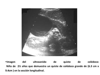 •Imagen del ultrasonido de quiste de colédoco:
Niña de 2½ años que demuestra un quiste de colédoco grande de (6.3 cm x
9.4cm ) en la sección longitudinal.
 