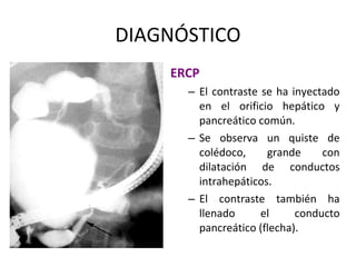 DIAGNÓSTICO
ERCP
– El contraste se ha inyectado
en el orificio hepático y
pancreático común.
– Se observa un quiste de
colédoco, grande con
dilatación de conductos
intrahepáticos.
– El contraste también ha
llenado el conducto
pancreático (flecha).
 
