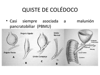 QUISTE DE COLÉDOCO
• Casi siempre asociada a malunión
pancratobiliar (PBMU)
 