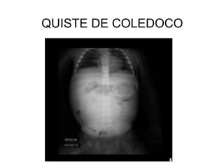 QUISTE DE COLEDOCO
 