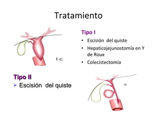 Tratamiento
Tipo I
• Escisión del quiste
• Hepaticojejunostomía en Y
de Roux
• Colecistectomía
Tipo IITipo II
 Escisión del quisteEscisión del quiste
 