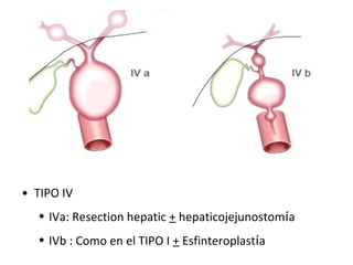 • TIPO IV
• IVa: Resection hepatic + hepaticojejunostomía
• IVb : Como en el TIPO I + Esfinteroplastía
 