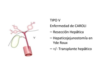 TIPO V
Enfermedad de CAROLI
– Resección Hepática
– Hepaticojejunostomía en
Yde Roux
– +/- Transplante hepático
 