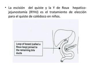 • La escisión del quiste y la Y de Roux hepatico-
jejunostomía (RYHJ) es el tratamiento de elección
para el quiste de colédoco en niños.
 