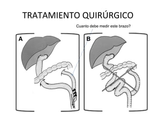 TRATAMIENTO QUIRÚRGICO
Cuanto debe medir este brazo?
 