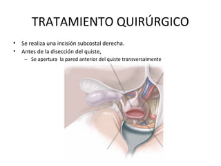 TRATAMIENTO QUIRÚRGICO
• Se realiza una incisión subcostal derecha.
• Antes de la disección del quiste,
– Se apertura la pared anterior del quiste transversalmente
 