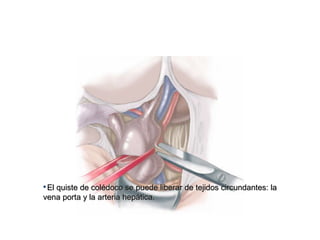
El quiste de colédoco se puede liberar de tejidos circundantes: laEl quiste de colédoco se puede liberar de tejidos circundantes: la
vena porta y la arteria hepática.vena porta y la arteria hepática.
 