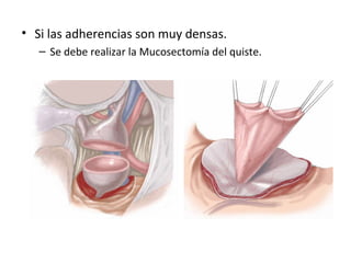 • Si las adherencias son muy densas.
– Se debe realizar la Mucosectomía del quiste.
 
