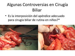 Algunas Controversias en Cirugía
Biliar
• Es la interposición del apéndice adecuado
para cirugía biliar de rutina en niños?*
 