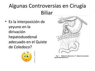 Algunas Controversias en Cirugía
Biliar
• Es la interposición de
yeyuno en la
dirivación
hepatoduodenal
adecuado en el Quiste
de Coledoco?
 