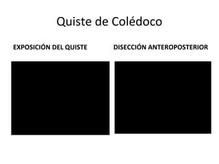 Quiste de Colédoco
EXPOSICIÓN DEL QUISTE DISECCIÓN ANTEROPOSTERIOR
 