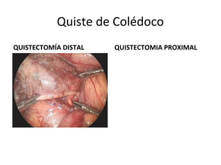 Quiste de Colédoco
QUISTECTOMÍA DISTAL QUISTECTOMIA PROXIMAL
 